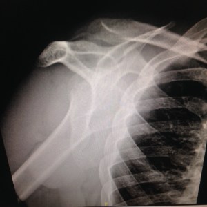 Dislocated Shoulder 1